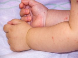 Do You Know About Food Allergies in Babies