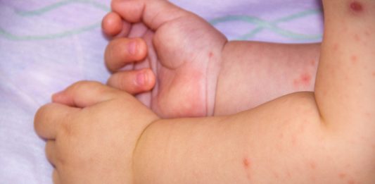 Do You Know About Food Allergies in Babies