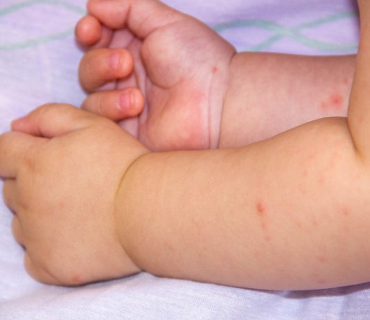Do You Know About Food Allergies in Babies