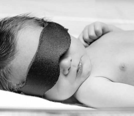 Prolonged Jaundice in Newborns - Causes, Symptoms, Investigation, And Treatment
