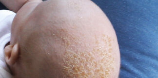 Common Questions About Cradle Cap In Babies