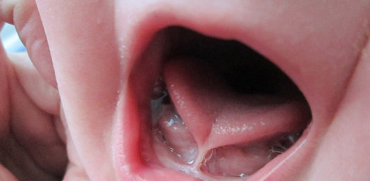 Ankyloglossia - Does Your Baby Have A Tongue Tie?