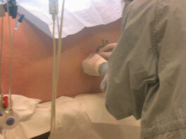 Pregnancy and birth: Risks And Side-effects of An Epidural