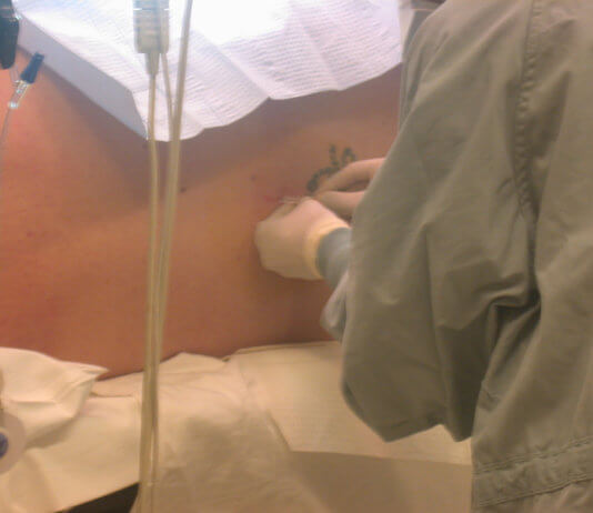 Pregnancy And Birth: Risks And Side-effects of An Epidural Pregnancy and birth: Risks And Side-effects of An Epidural