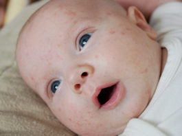 Baby Acne on Infants and Newborns