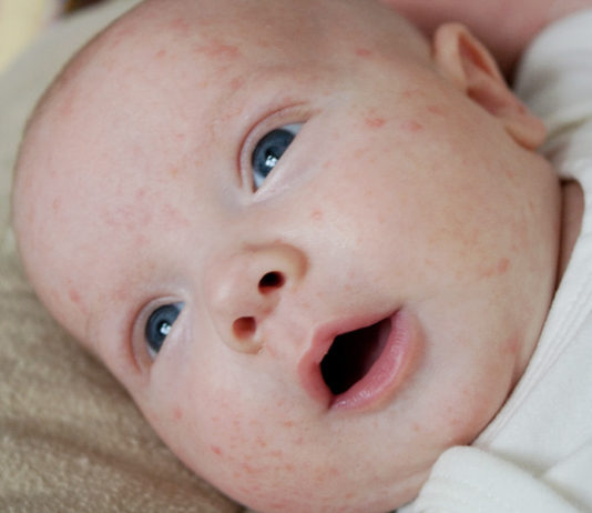 Baby Acne on Infants and Newborns Baby Acne on Infants and Newborns