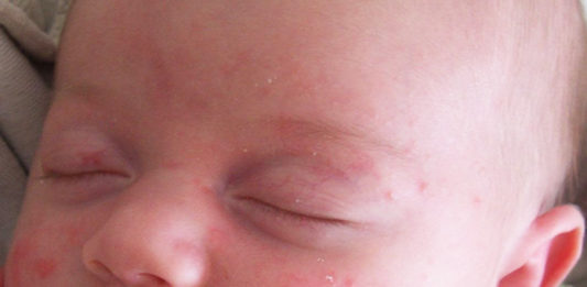 Baby Acne Treatment – How To Treat And Prevent Baby Acne Baby Acne Treatment - How To Treat And Prevent Baby Acne