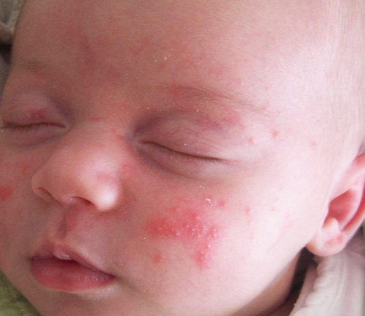 Baby Acne Treatment - How To Treat And Prevent Baby Acne