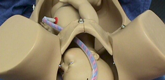 Causes And Dangers Associated With Umbilical Cord Prolapse
