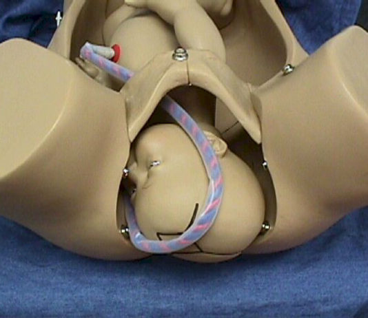 Causes And Dangers Associated With Umbilical Cord Prolapse Causes And Dangers Associated With Umbilical Cord Prolapse
