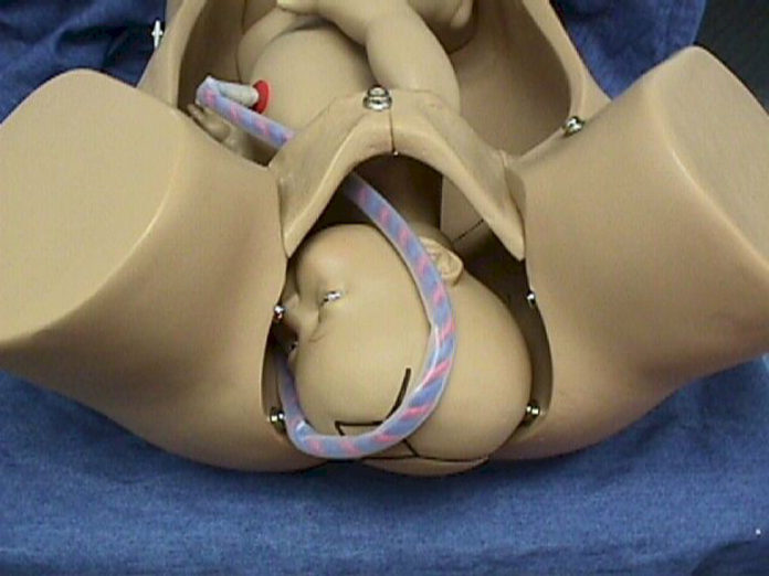 Causes And Dangers Associated With Umbilical Cord Prolapse Causes And Dangers Associated With Umbilical Cord Prolapse